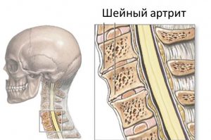 Шейный артрит