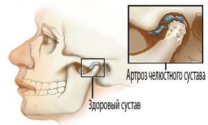 Артроз ВНЧС