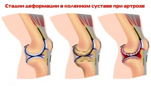 Деформация коленного сустава