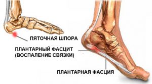 Фасцит и пяточная шпора