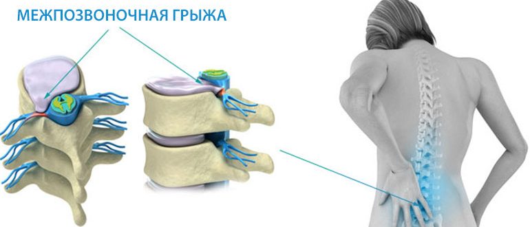 подарок лечение межпозвоночной грыжи в янцзы инженерная