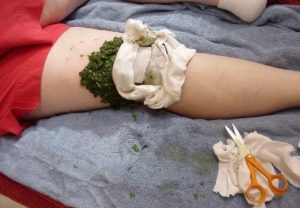 Компресс из кашицы листьев