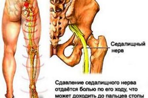 Невралгия седалищного нерва