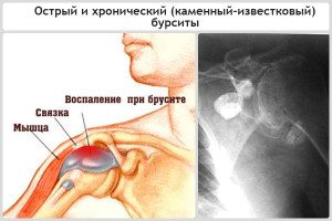 Особенности бурсита
