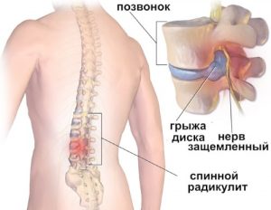 Радикулит