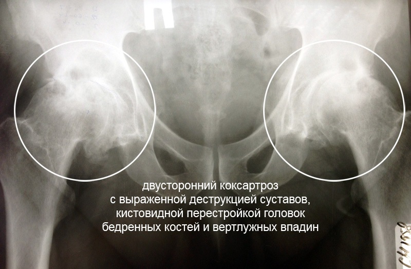 Какая рентгенологическая картина характерна для начальных форм коксартроза