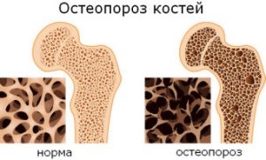 Остеопороз и степени