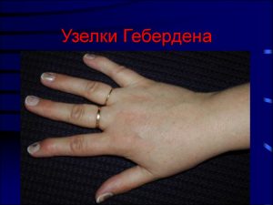 Узелки Гебердена