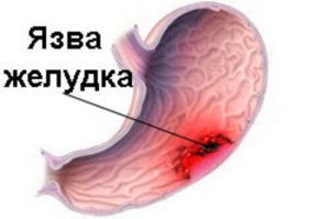Язва желудка