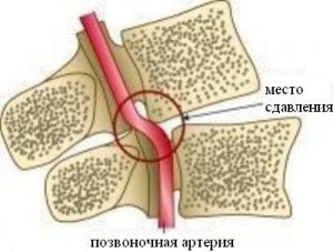 Вывих шейного отдела позвоночника