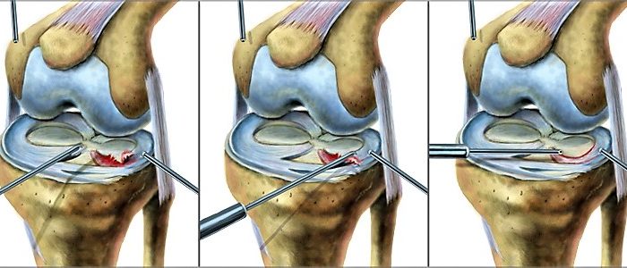 Разрыв медиального мениска коленного сустава - лечение и операция в Москве.